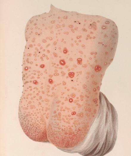 shingles in a child