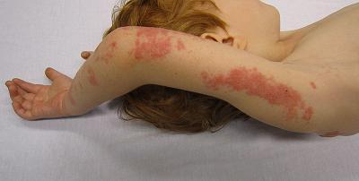 how to treat herpes in children