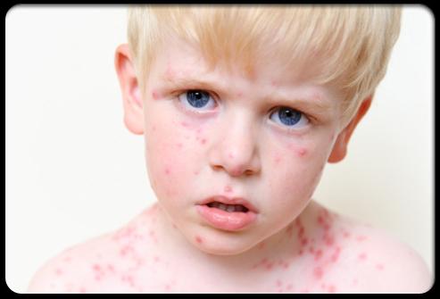 带状疱疹在儿童的脸上