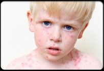Ringworm in a child
