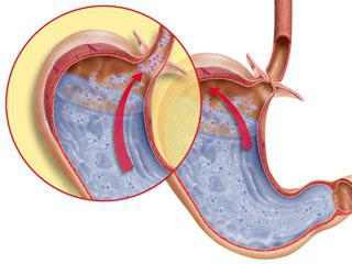 reflux of bile into the stomach causes