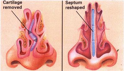 surgery repair of nasal septum reviews