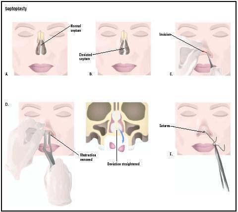 correction of nasal septum laser