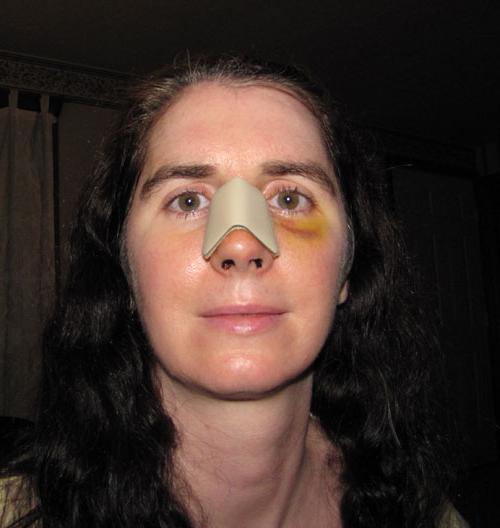 after correction of the nasal septum