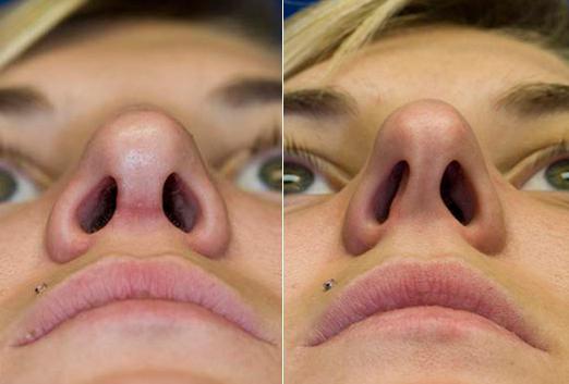 métodos de correção nasal divisória