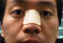 O que você precisa fazer se você quebrou o nariz?