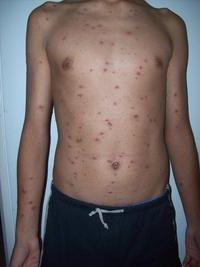 pigment spots on the body causes