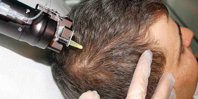 фракционная mesoterapia do couro cabeludo