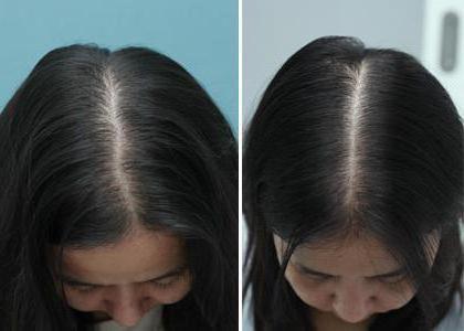 la mesoterapia en el cuero cabelludo que esqué son los efectos secundarios