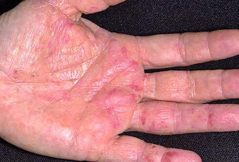 creme de alergias na pele em adultos hormonais
