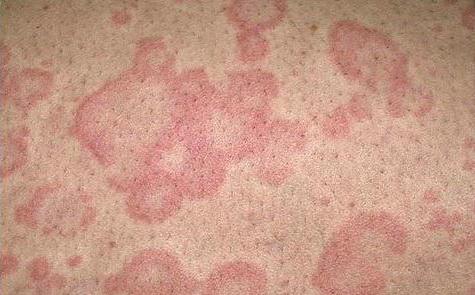 крем від алергії на шкірі у дорослих негормональні