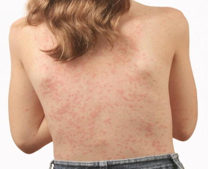 la crema de la alergia en la piel en los adultos la eficacia de la