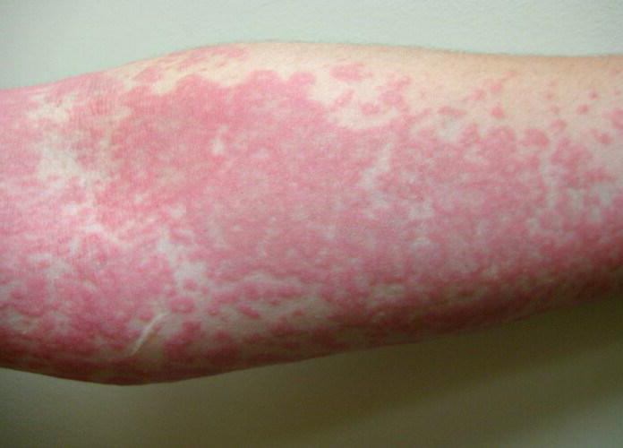 la crema de la alergia en la piel de los adultos a los clientes