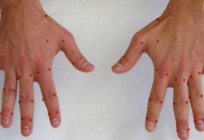 Die Punkte auf den Händen, die für die Organe. Akupunkturpunkte auf der Hand (Foto)