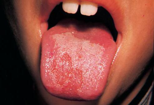 sores on the tongue and the palate