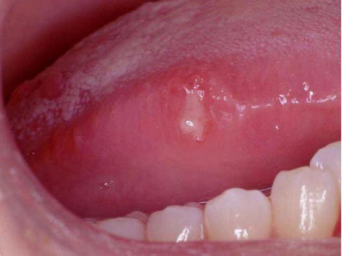 Ulcer On The Tongue In Children Causes Treatment Prevention
