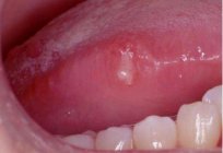 Ulcer on the tongue in children: causes, treatment, prevention