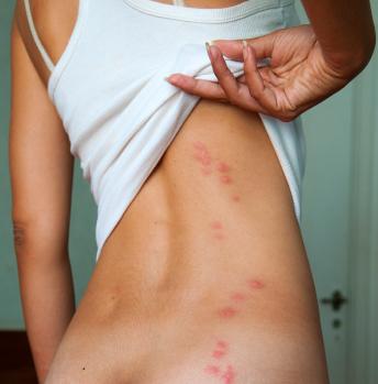 allergisch auf Mückenstiche Foto