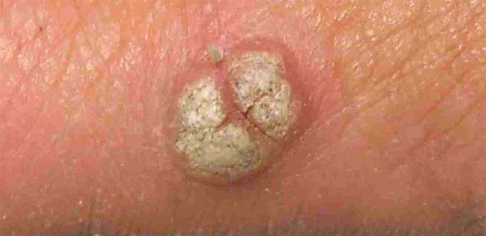 warts on the genitals
