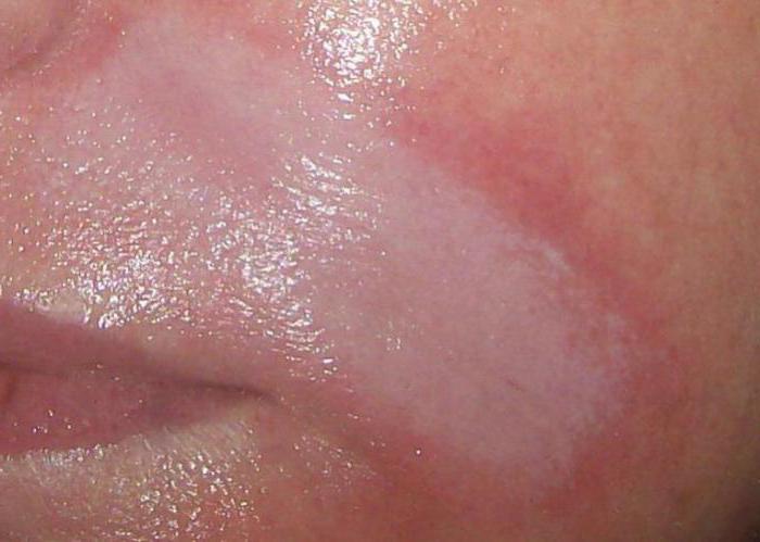 Hyaluronsäure in die Lippen Gästebewertungen Fotos