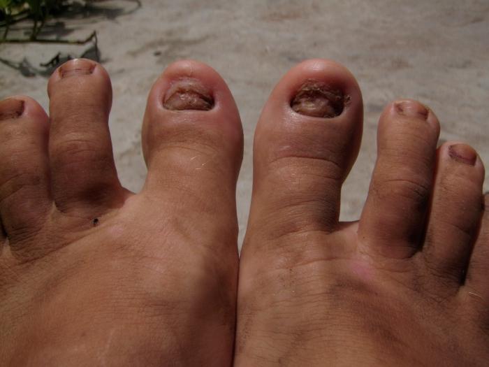 enclavada la uña en el dedo del pie