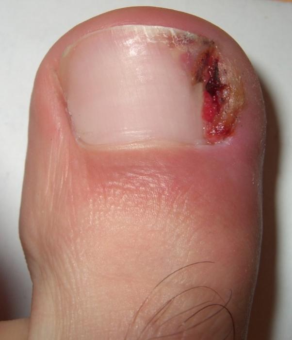 why grow toenails