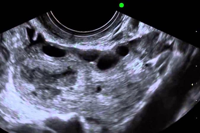 ultrasound folliculometry