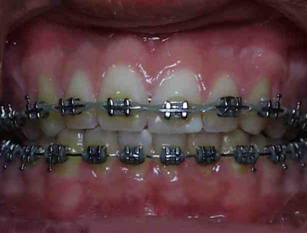 metal braces photo