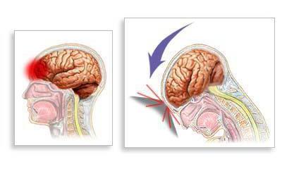 Gehirnerschütterung Symptome und Behandlung