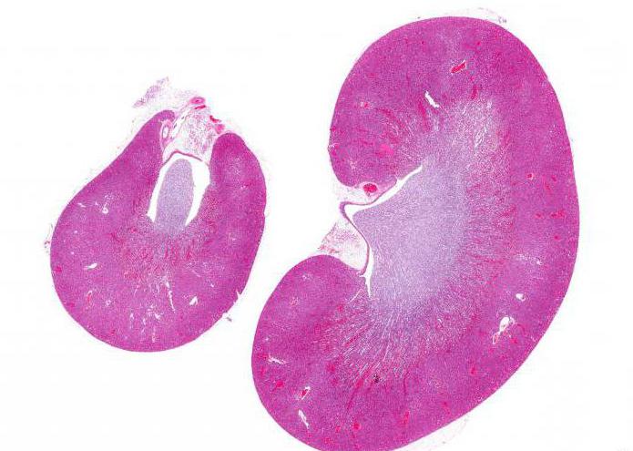histology of kidney tumor