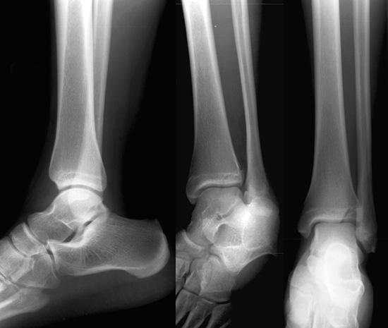 x-ray ayak bileği