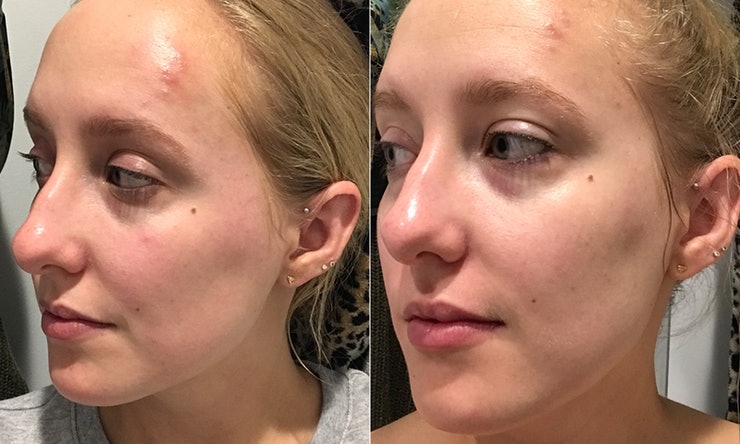 foto do antes e depois da operação