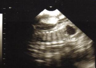 fetometry fetus ZZ weeks