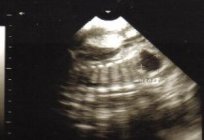 Фетометрия fetus hafta hafta. Boyut fetus hafta hafta