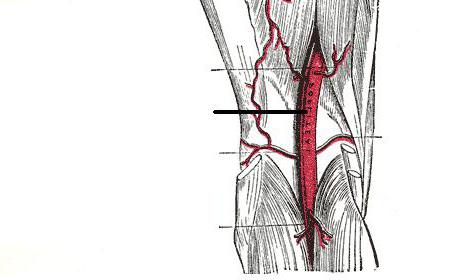 ligation of the popliteal artery