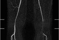 Cojín de rodilla arteria: anatomía y topografía. La patología de la arteria podkolennoy