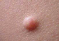 From what appear to be a papilloma? The causes of disease, methods of removing papillomas
