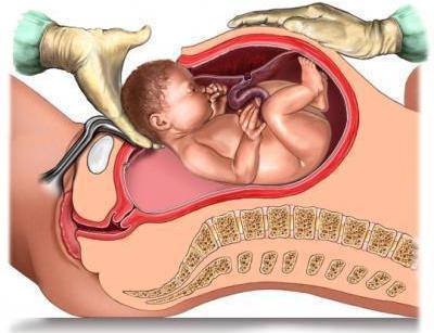 die Narbe auf der Gebärmutter in der Schwangerschaft