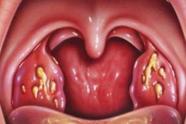 belirtiler kronik tonsillit yetişkin