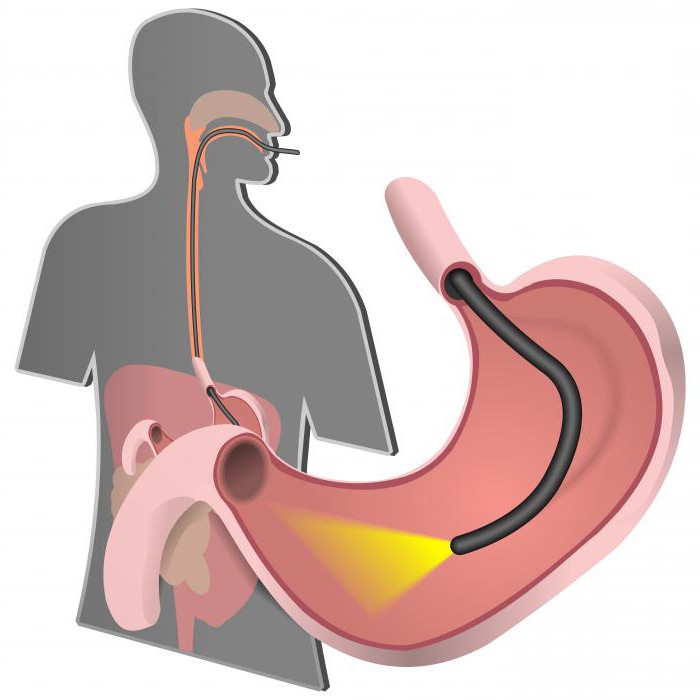 subatrophic胃炎の治療