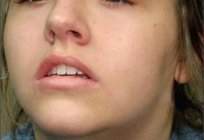顎下lymphadenitis:症状と治療