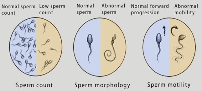 निदान के teratozoospermia