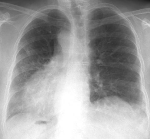 何構造の肺の