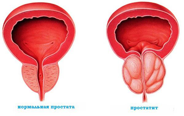 Behandlung Prostatitis
