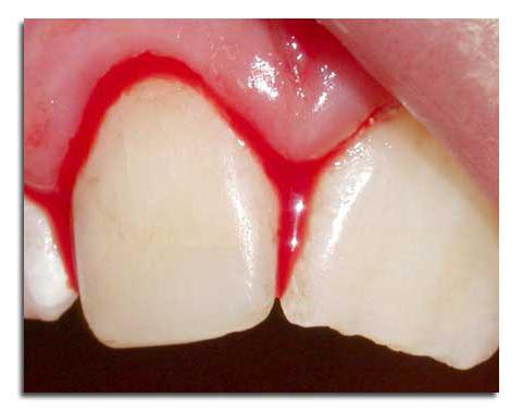 牙龈出血在怀孕期间