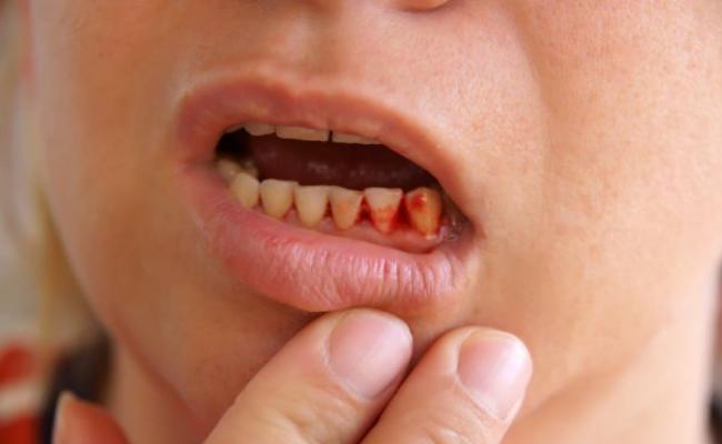 歯ぐきの出血、妊娠中の学期の写真