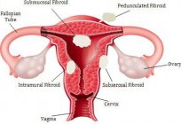 の子宮筋腫に妊娠すか？ 何が問題なのでしょうか。