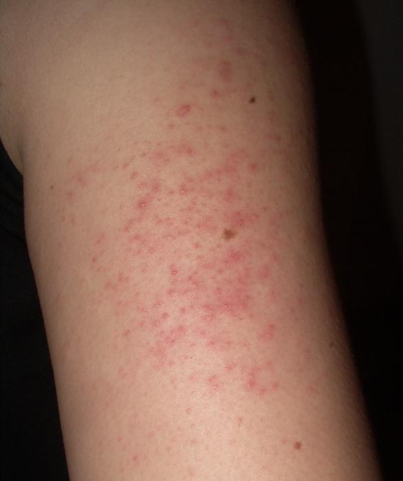 pimples on the arms above the elbow