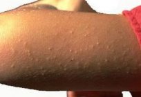 Pimples on the arms above the elbow: how to get rid of?