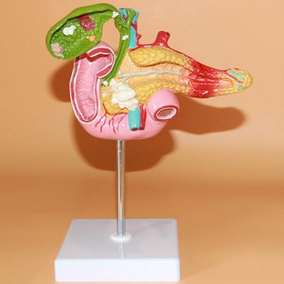 empyema of the gall bladder